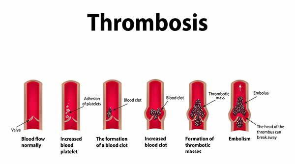 Infographie sur la thrombose